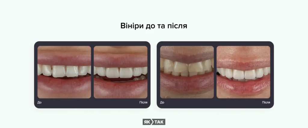 Усмішка з вінірами до та після встановлення