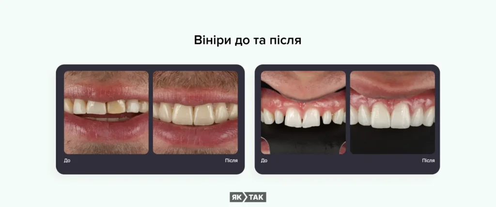 Вініри до та після